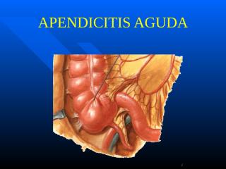 Apendicitis aguda.ppt